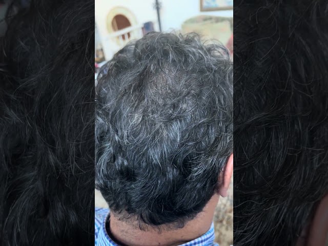 Part Two, Ray's Density Treatment, SMP Healed results. #hair #scalpmicropigmentation #hairline