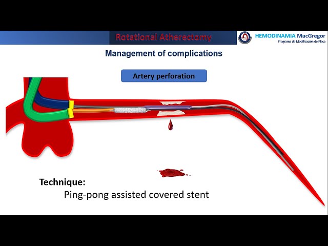 Ping-pong technique in coronary perforation