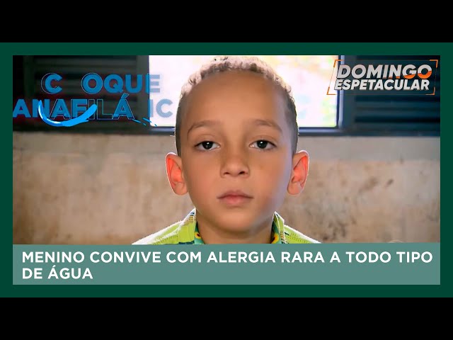 Caso raro: O Menino que tem alergia a todo tipo de água | Domingo Espetacular