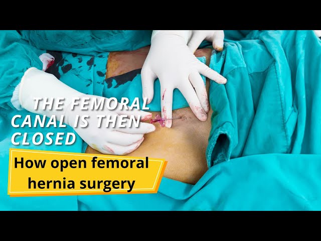 How open femoral hernia surgery with Mesh