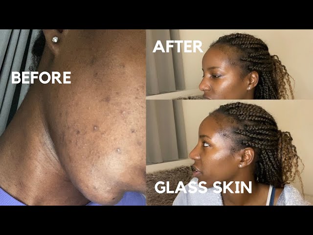 I FADED MY DRY TEXTURED SKIN | HOW I KEEP MY SKIN CLEAR AND GLOWING