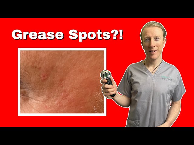 How to Get Rid of Sebaceous Hyperplasia: Complete Guide to Sebaceous Hyperplasia