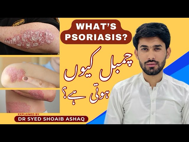 Psoriasis causes, symptoms and types in hindi/urdu | chambal ku hoti hai | Dr syed shoaib ashaq