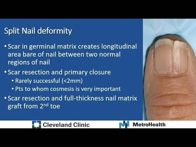 Nail & Nail Bed Conditions - Dayton Opel, MD