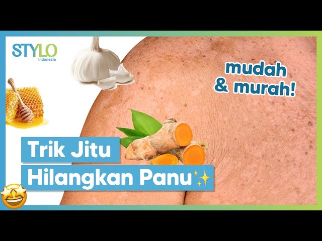 Cara Cepat Menghilangkan Panu Menggunakan Bahan Alami, Mudah dan Efektif! | Stylo