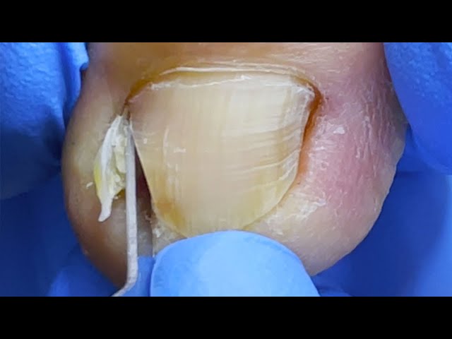 Removal of a small sharp pin in the toenails