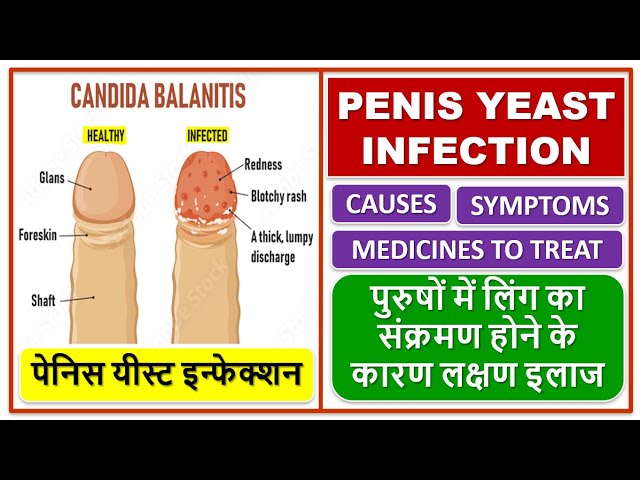 PENIS YEAST INFECTION, TREATMENT, पेनिस यीस्ट इन्फेक्शन, लिंग का संक्रमण होने के कारण लक्षण इलाज