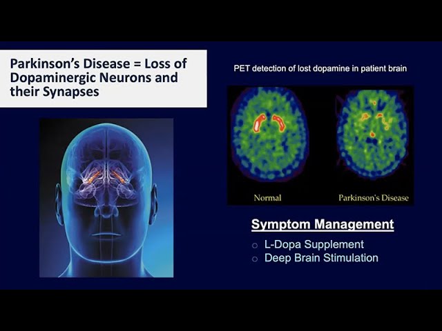 Creating New Neurons: The Potential to Reverse Parkinson’s Disease