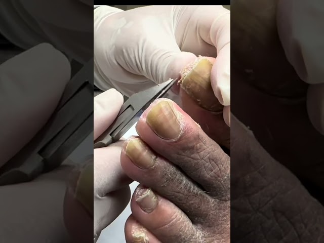 THICK Nail Cutting