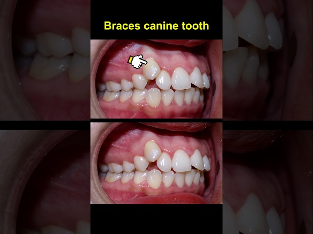 Braces crooked teeth evolution #braces #orthodontist #bracket #dentist