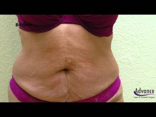 Abdominoplasty | Tummy Tuck Before & After | Orange County | Dr Tim Roham, Advance Laser & Cosmetics