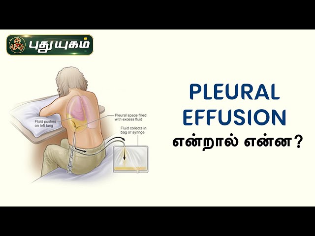 Pleural effusion என்றால் என்ன? | Dr.கௌதமன் | PuthuyugamTV