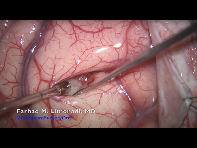 Brain tumor surgery in a lady who was paralyzed because of the tumor.