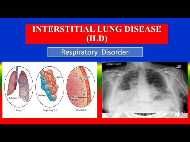 INTERSTITIAL LUNG DISEASE (ILD) - Definition, types, causes, pathophysiology,  diagnoses , medicine