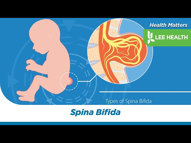 Spina Bifida