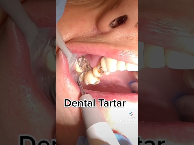 Dental TARTAR !!