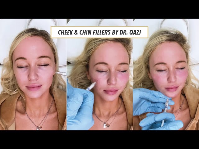 Cheek and Chin Filler by Dr. Nadir Qazi