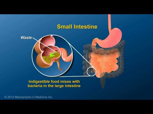 What is an Ileostomy?