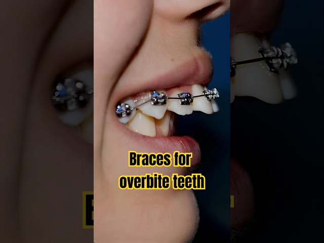 Braces for overbite teeth transformation #braces #orthodontist #dentist