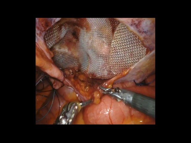 Robotic assisted supravesical hernia repair with mesh by Dr. Iraniha