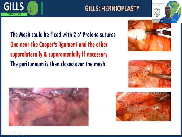 103) GILLS Hernioplasty Summary