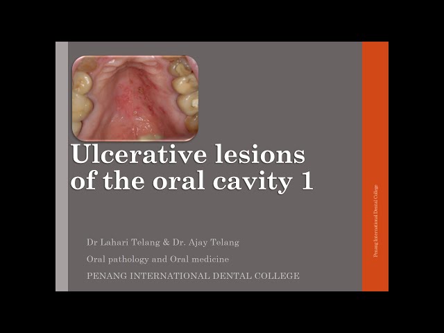 Ulcerative lesions of the oral cavity 1