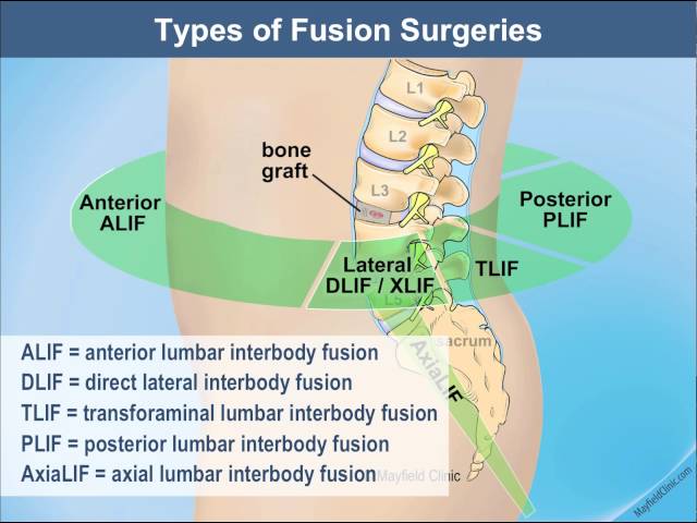 Same Day Lumbar Spine Fusion Surgery