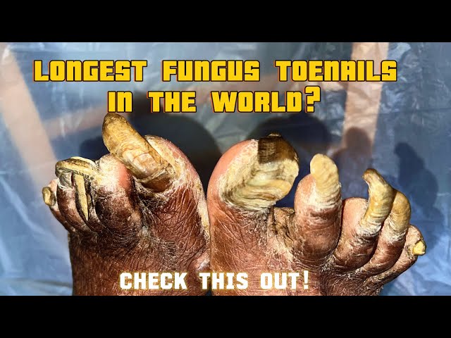 Extremely fungal thickened toenails I Onychogryphosis Transformation: Trust Your Podiatrist