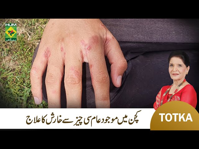 Zubaida Apa Totka | Kharish Khatam Karney ka Gharelu Ilaj | Scabies Infection Treatment | MasalaTv