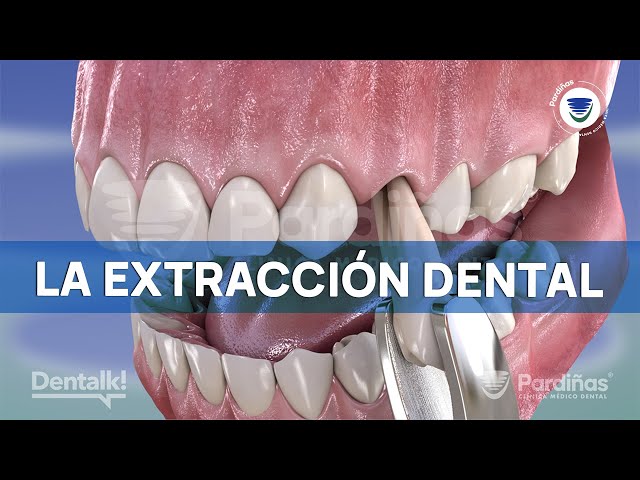 Tooth Extraction - How it's done and when it's necessary to remove a tooth ©