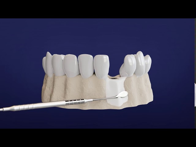 Step by Step Guide to Your Dental Implant Procedure