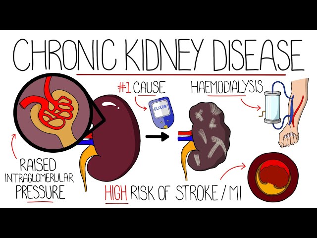 Understanding Chronic Kidney Disease (CKD)