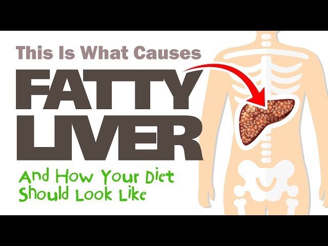 ❤️This Is What Causes Fatty Liver And How Your Diet Should Look LIke