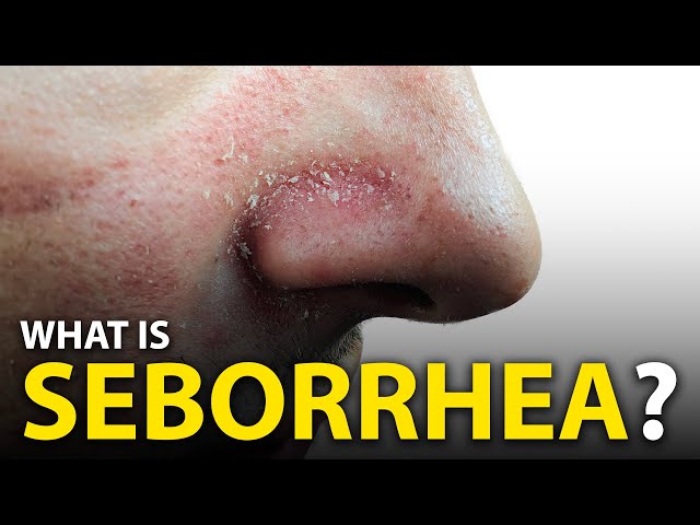 How To Get Rid Of Seborrheic Dermatitis? (DANDRUFF)