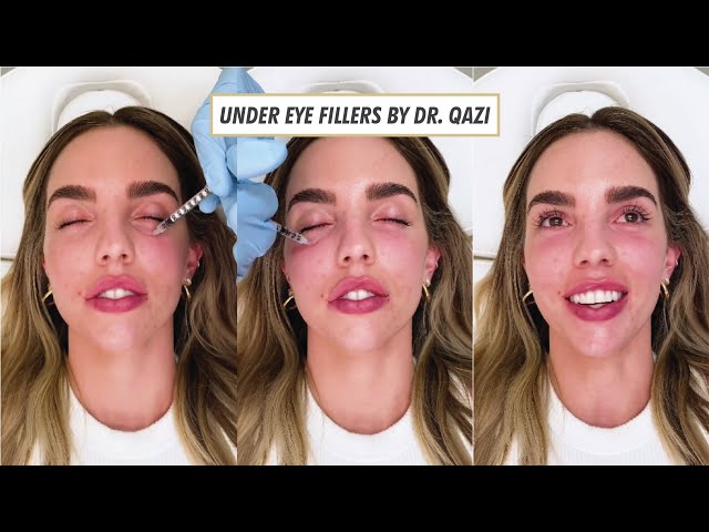 Undereye Filler by Dr. Qazi