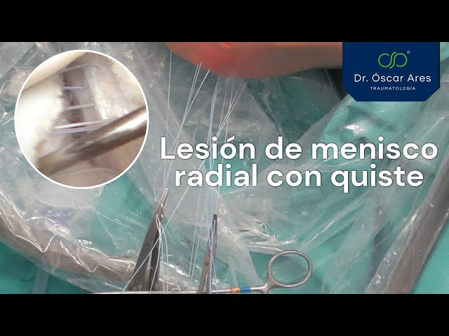 Lesión de menisco radial con quiste - Dr. Oscar Ares