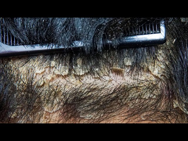 Dandruff scratching removal on head using black combing #