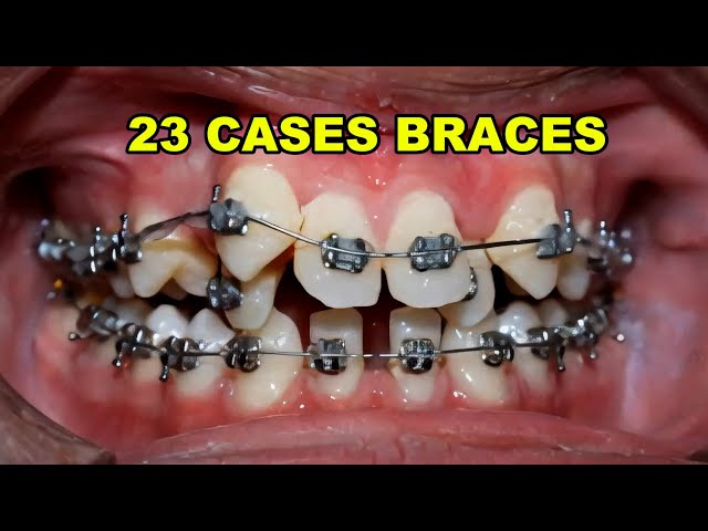 23 Case Braces Transformation