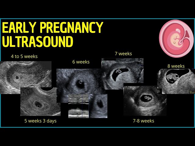 Early Pregnancy Ultrasound: A Deep Dive into First Trimester Insights #pregnancyultrasound