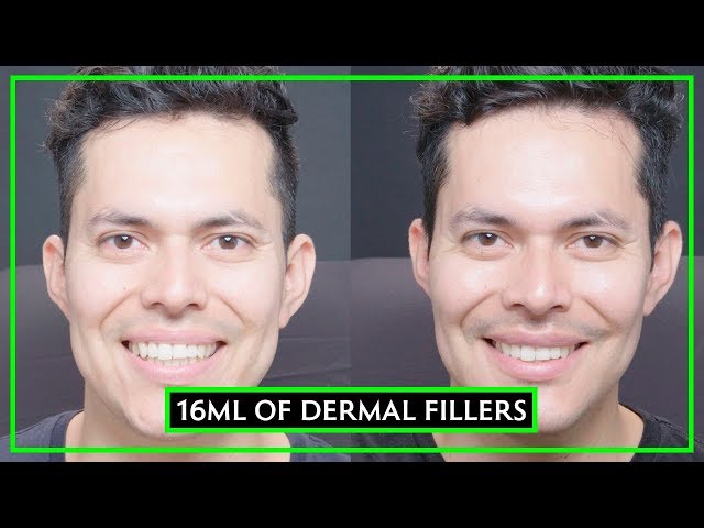 16 Syringes Of Dermal Filler Male Make-Over