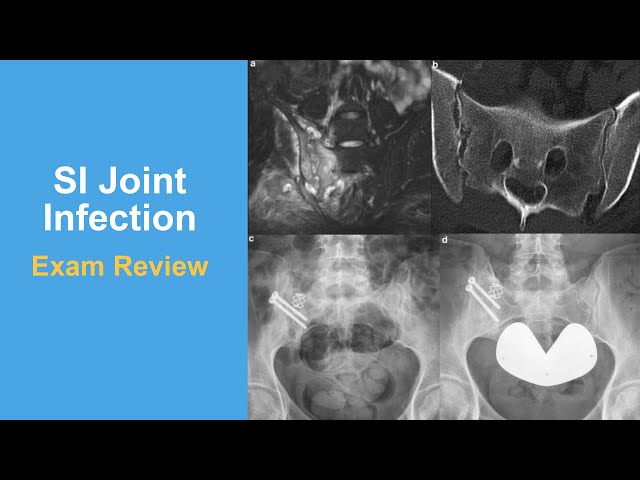 SI Joint Infection Exam Review - Michael Glotzbecker, MD