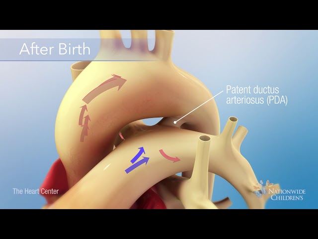 Patent Ductus Arteriosus (PDA) Occlusion Procedure