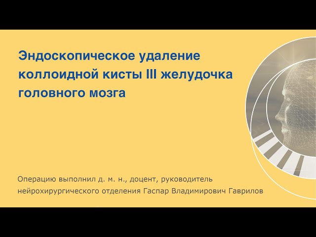 Эндоскопическое удаление коллоидной кисты III желудочка головного мозга