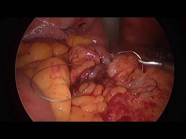 Laparoscopic right Hemicolectomy for colon cancer with Intracorporeal Anastomosis by Dr. Iraniha