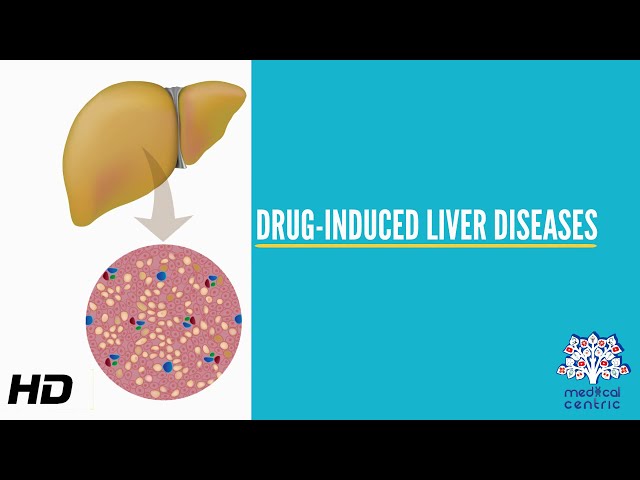 Drug-Induced Liver Disease, Causes, Signs and Symptoms, Diagnosis and Treatment.