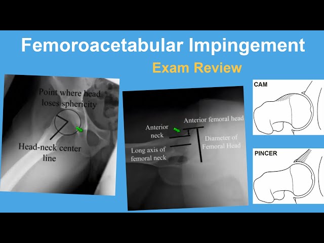 Femoroacetabular Impingement Exam Review - Ernie Sink, MD