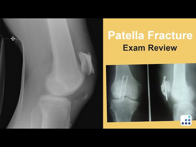 Patella Fracture Exam Review - C. Lowry Barnes, MD