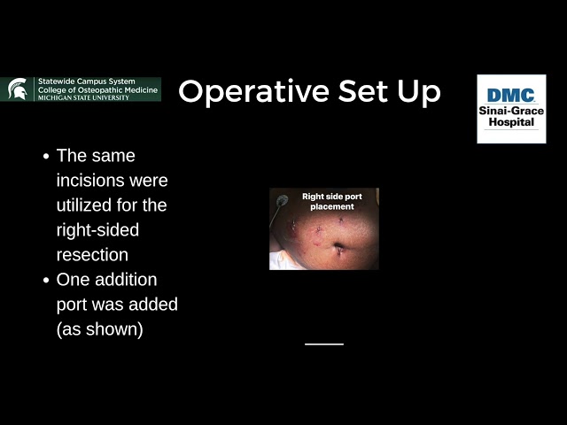 Robotic Assisted Bilateral Adrenalectomy for Pheochromocytomas