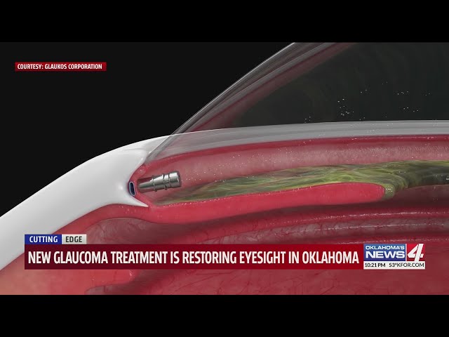 New glaucoma treatment is restoring eyesight in Oklahoma