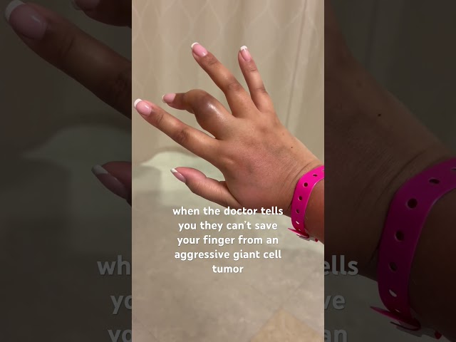 Finger amputation #fingersurgery  #benign #giantcelltumor #amputee #amputation #rayamputation